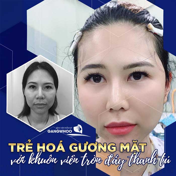 Cấy Mỡ Làm Đầy Thái Dương