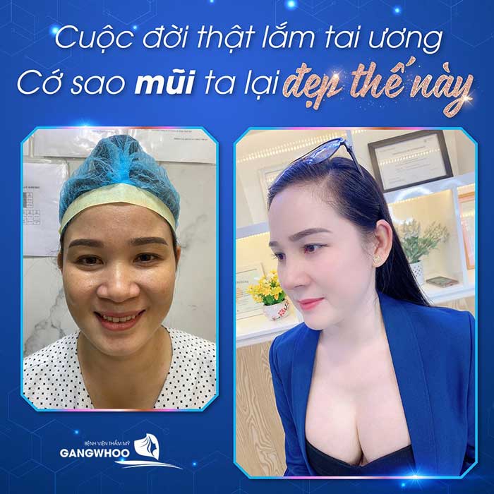 cơ địa sẹo lồi vẫn có thể nâng mũi bình thường