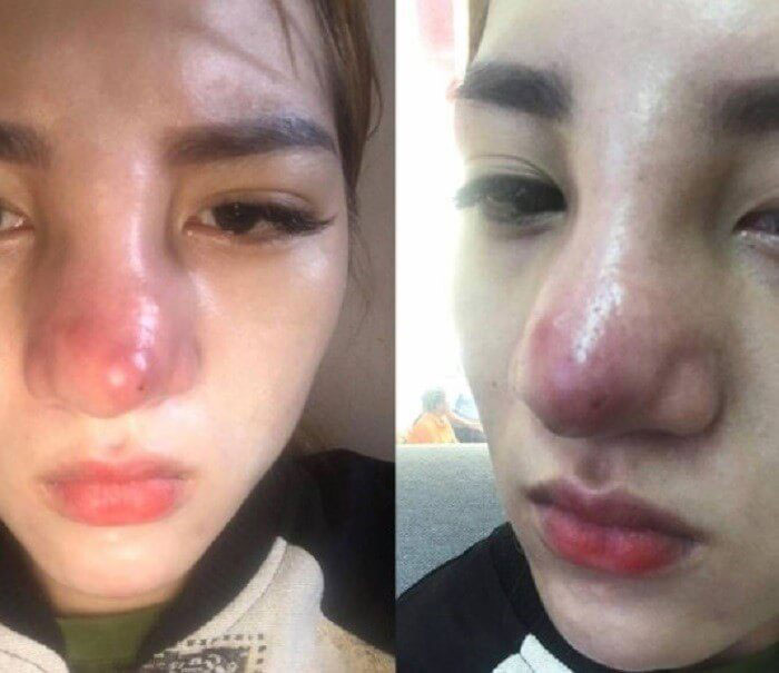 Một biến chứng khi phẫu thuật nâng mũi tại địa chỉ kém uy tín