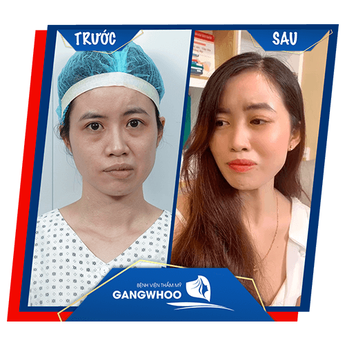khách hàng sau khi điều trị liệt mặt