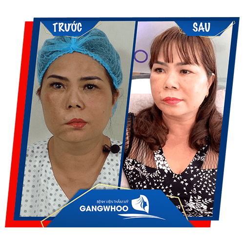 khách hàng sau khi điều trị liệt mặt