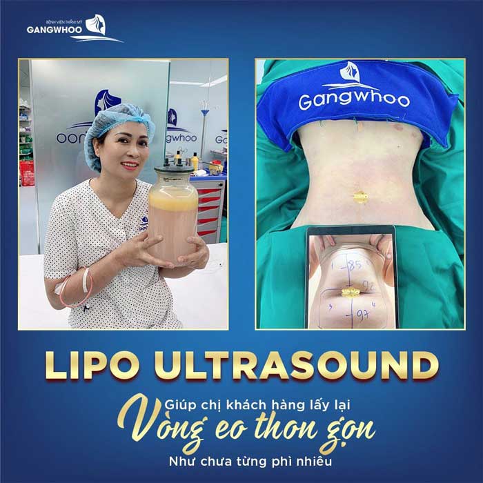 Giá giảm béo Lipo Ultrasound là: 10 triệu/1 vùng