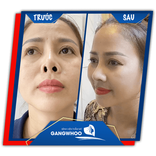 Khách hàng sửa mũi hỏng trước và sau