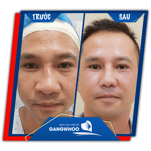 Khách hàng sửa mũi hỏng trước và sau