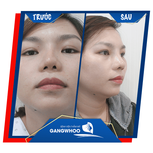 Khách hàng sửa mũi hỏng trước và sau