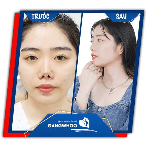 Khách hàng sửa mũi hỏng trước và sau