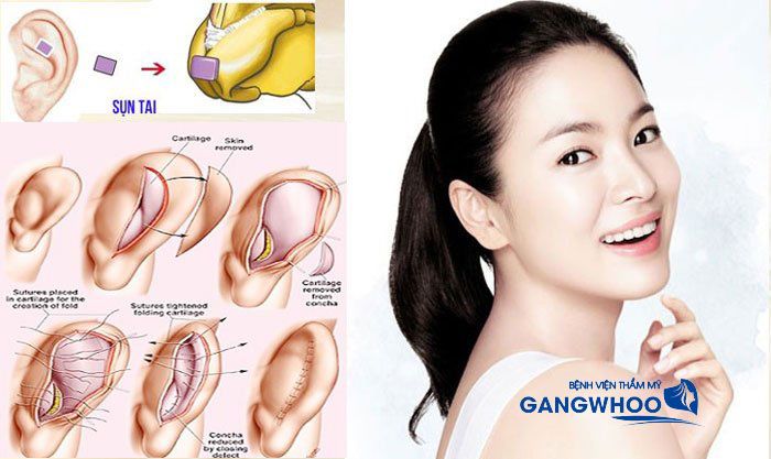 Nâng mũi bằng sụn tai giúp hạn chế phát sinh biến chứng sau nâng mũi