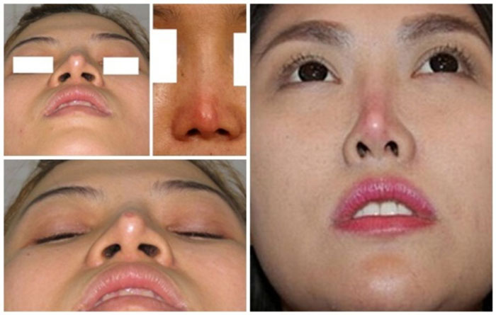 hình ảnh nâng mũi bị tụt sụn