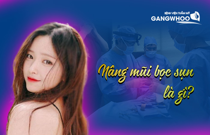 Phẫu thuật nâng mũi bọc sụn là gì?