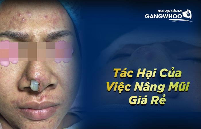 Những tác hại của việc nâng mũi giá rẻ