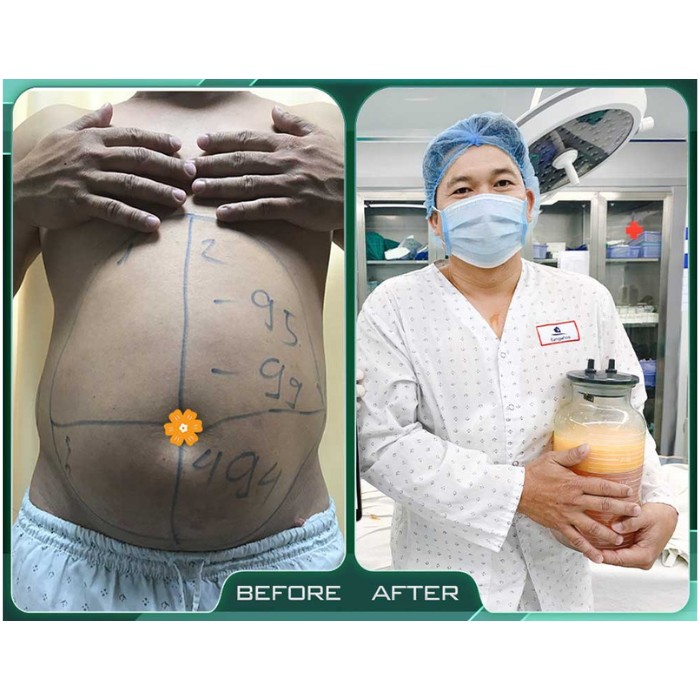 Đối tượng phù hợp để hút mỡ công nghệ cao Lipo Ultrasound