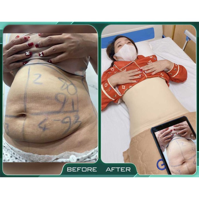 Ưu điểm của công nghệ Lipo Ultrasound