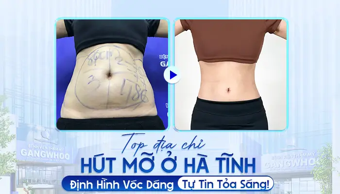 Top Địa Chỉ Hút Mỡ Ở Hà Tĩnh: Định Hình Vóc Dáng, Tự Tin Tỏa Sáng!