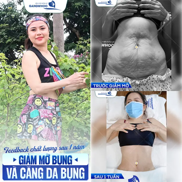 Hút Mỡ Ở Thanh Hóa Cơ Sở Nào An Toàn Và Hiệu Quả?