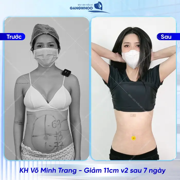 Điểm Danh 4 Cơ Sở Hút Mỡ Ở Trà Vinh Được Đánh Giá Cao