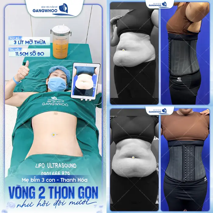 Bí Kíp Đánh Bay Mỡ Thừa – Đâu Là Địa Chỉ Hút Mỡ Ở Thái Nguyên Tốt?
