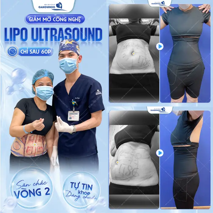 Bí Kíp Đánh Bay Mỡ Thừa – Đâu Là Địa Chỉ Hút Mỡ Ở Thái Nguyên Tốt?